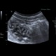 Gastroenteritis, acute, diarrhea: US - Ultrasound